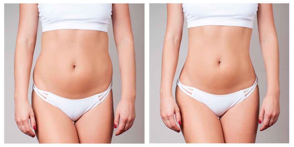 Should you consider CoolSculpting for stubborn fat? Find here