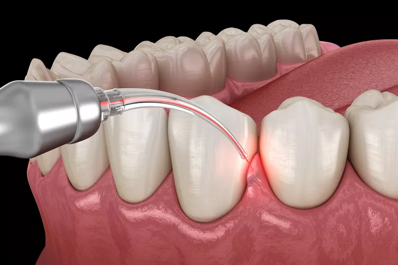 How Periodontists Use Lasers In Gum Disease Treatment